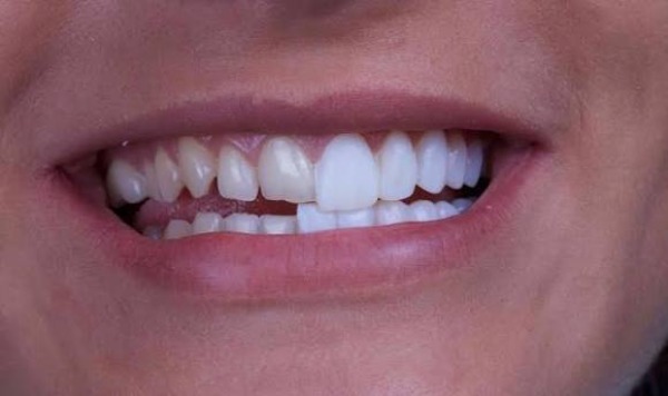 Vì sao bọc răng sứ bị tụt lợi?