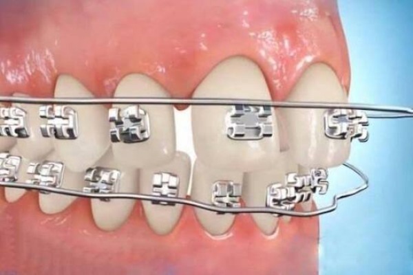 Rủi ro nếu để mắc cài rớt quá lâu?