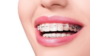Có Thể Hôn Khi Đang Niềng Răng Không?