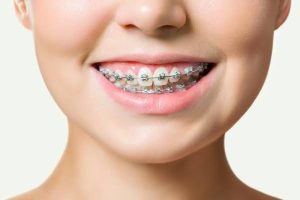 Mắc cài niềng là gì và tại sao bị rớt?