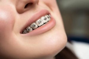 Niềng răng có hôn được không? Câu trả lời từ chuyên gia