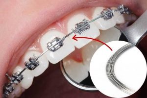 Làm sao thực hiện mài kẽ và chăm sóc sau đó?