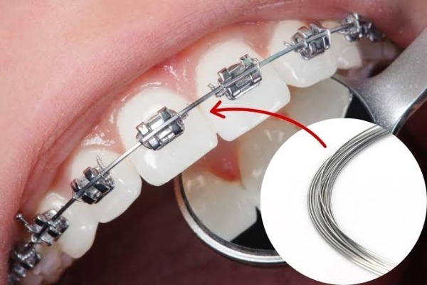 Làm sao thực hiện mài kẽ và chăm sóc sau đó?