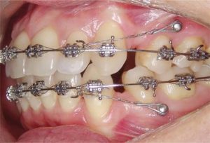 Mài kẽ răng khi niềng có ảnh hưởng không? Sự thật từ chuyên gia