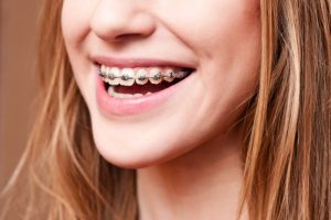 Tháo niềng răng sớm có sao không? Rủi ro và khuyến cáo y khoa