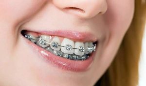 Mắc cài niềng rớt phải làm gì? Hướng dẫn xử lý từ nha sĩ