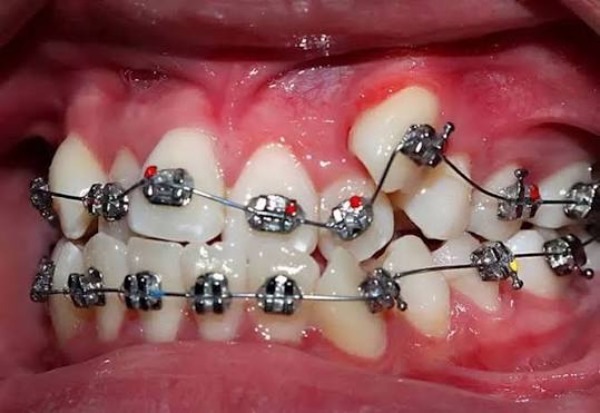 Niềng răng khểnh có giữ được không? Điều cần biết