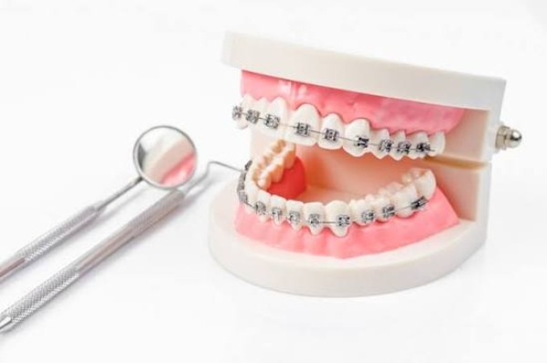 Mài kẽ răng là gì và tại sao cần làm khi niềng?