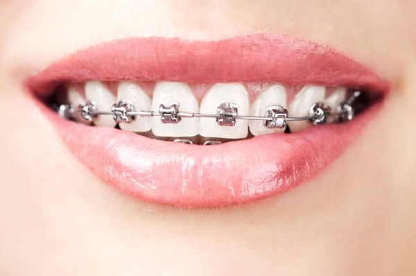 Chăm sóc sau khi tiêm filler trong quá trình niềng