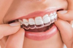 Không đeo hàm duy trì sẽ xảy ra gì?