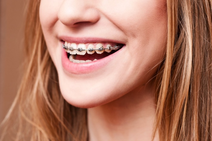 Tháo niềng răng sớm có sao không? Rủi ro và khuyến cáo y khoa