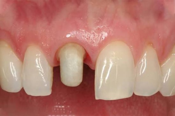 Tháo bọc sứ có đau không?