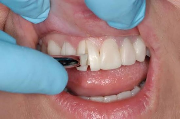 Tháo bọc sứ có đau không: sự thật từ nha khoa