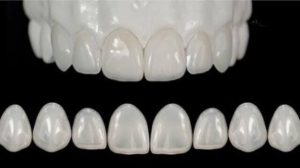 Tại sao tẩy trắng chỉ tác dụng trên răng thật?