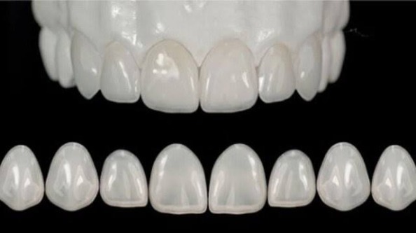 Bọc răng sứ là gì?