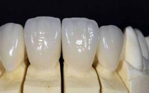 Những yếu tố nào ảnh hưởng đến chi phí bọc sứ Emax?