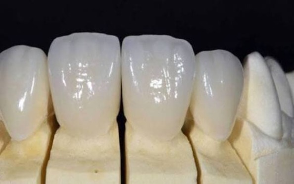 Những yếu tố nào ảnh hưởng đến chi phí bọc sứ Emax?